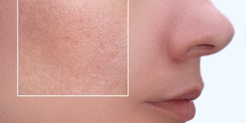 Open pores treatment at home for oily skin